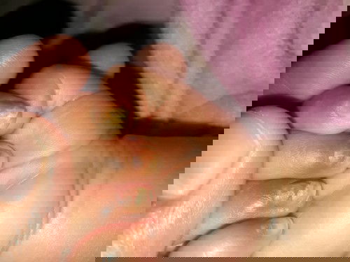 Sedih karena kuku anak ku