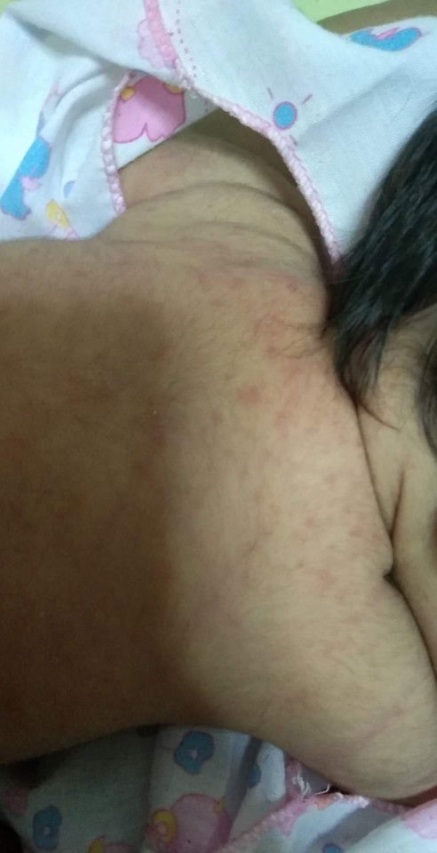 ผื่นแบบนี้จะหายเองใช่ไหมค่ะ