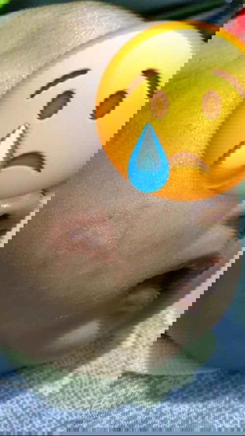 Bercak merah di pipi