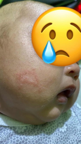 Bercak merah di pipi