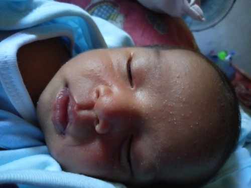 Ano po gamot dito sa face ni baby?