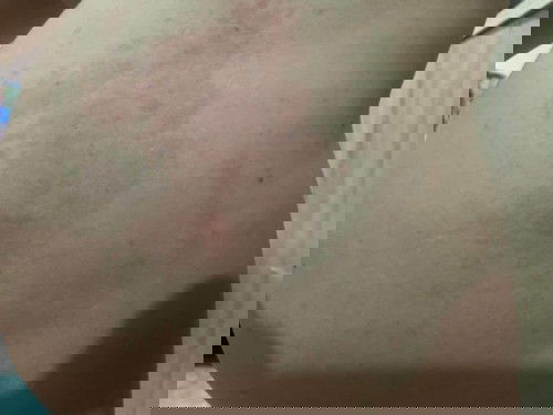 ผื่นคันที่หน้าท้อง ตั้งครรภ์ได้จะครบ 20W ค่ะ