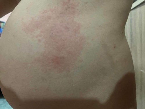 ผื่นคันที่หน้าท้อง ตั้งครรภ์ได้จะครบ 20W ค่ะ