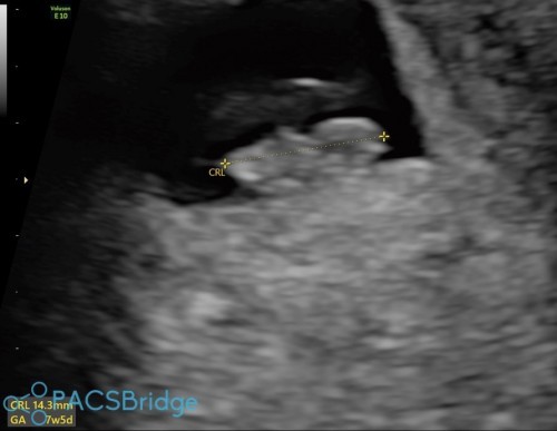 Baby no.2