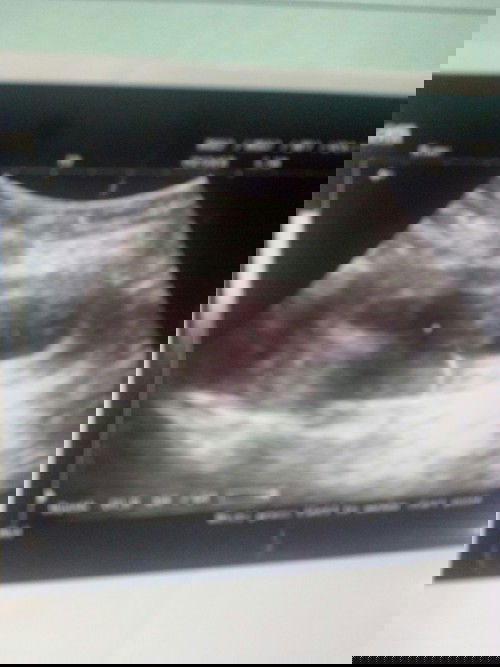 Baru ketahuan hamil 10 minggu