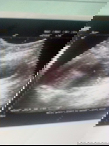 Baru ketahuan hamil 10 minggu