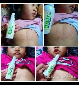 NBS mengatasi kulit bayi