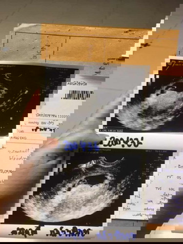 อาการปวดท้อง