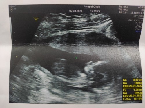 ตอนนี้ ตั้งครรภ์ได้ 16 วีคแล้วคะ แต่ติดโควิดซะก่อน เครียดมากเลยคะ รอ รพ ติดต่อกลับมาคะเป็นห่วงลูกจัง