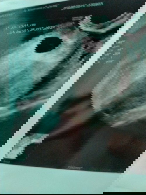 usia kandungan 6minggu blm terlihat janin