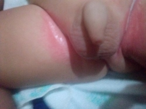ขาหนีบน้องแดง