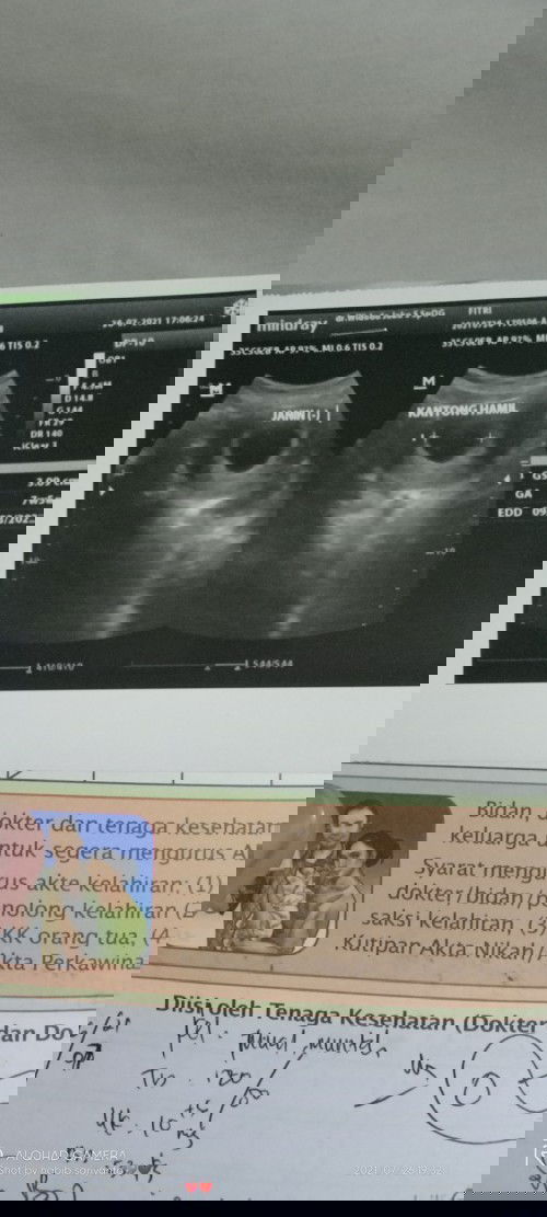 #USG Gak ada janinnya