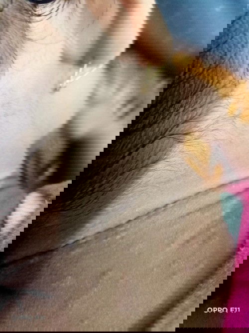 Biang keringat / melepuh