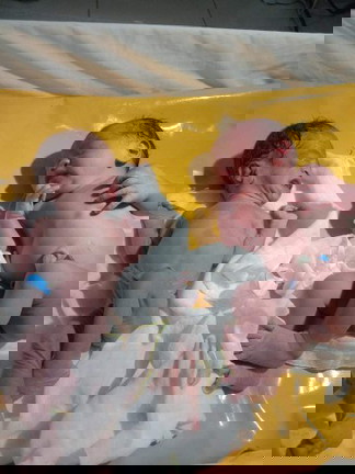 Twin Babies not same birth weight