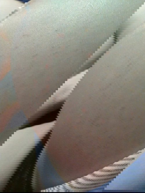 ท้องใหญ่ทาครีมอะไรก็เป็นตุ่มแดงๆคันทาน้ำมันออยก็ตุ่มแดงแบบนี้