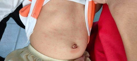 bị này là bị gì v ạ