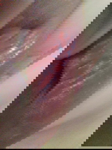 Cracked nipples