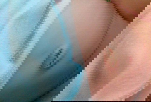 Pusar bodong karena ngeden dan ngulet