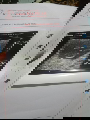 Bun aku mau nanya usia kandunganku sudah jalan 9 minggu kata bidan aku, tapi pas USG baru 7 minggu d