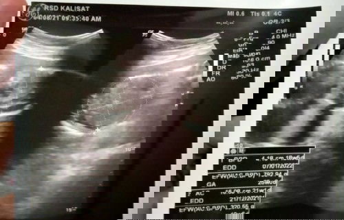 Tidak merasakan gerakan janin.
