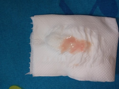 แบบนี้ใช่มูกเลือดมั้ย