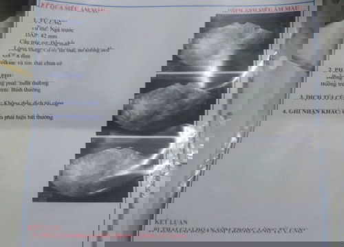 Siêu âm thai sớm