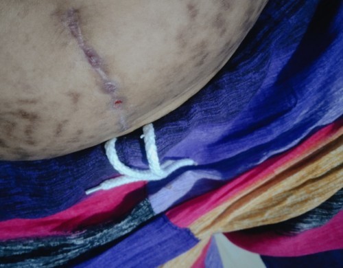 Ask ko lang po may possibility ba na bumuka yung tahi sa loob bigla nalang kasing namaga.