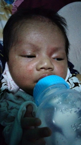 bintik putih seperti jerawat di wajah bayi