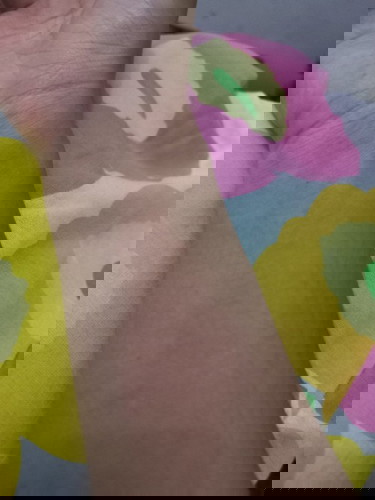 Gatal-gatal UK.23 weeks