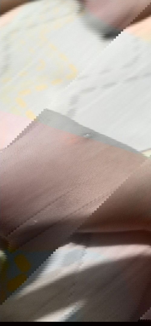 Awalnya bentol tapi 2 hari malah seperti kutu air