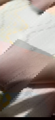 Awalnya bentol tapi 2 hari malah seperti kutu air