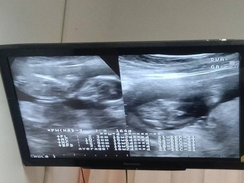 อัลตร้าซาวด์