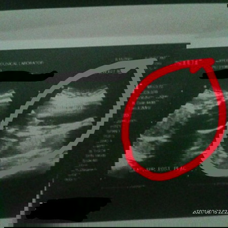 Ultrasound
