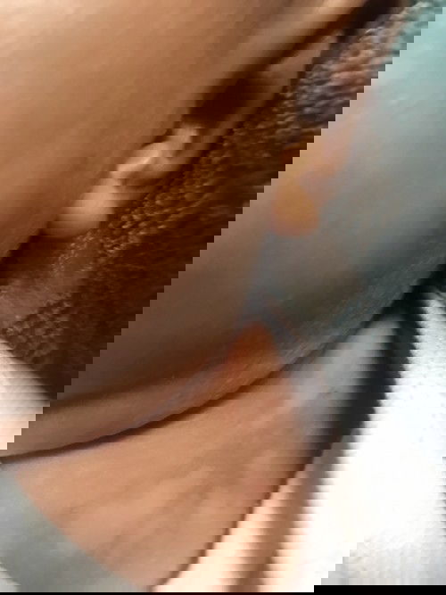 ลูกเป็นผื่นตามซอกคอและกากน้ำนมควรรักษายังไงคะ