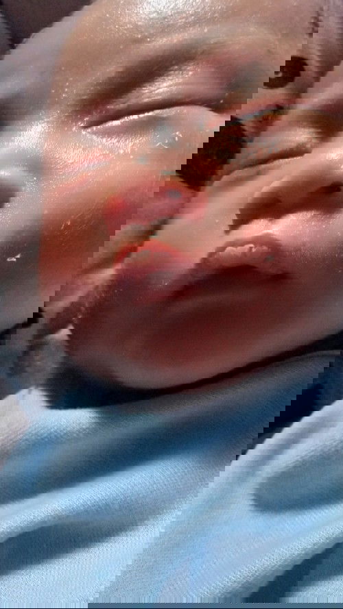 Bibir putih kering dan lidah putih