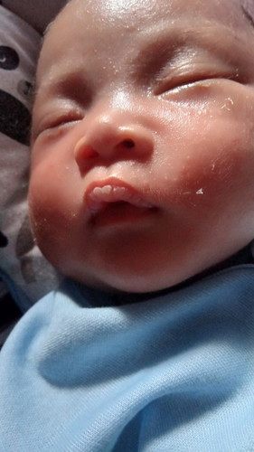 Bibir putih kering dan lidah putih