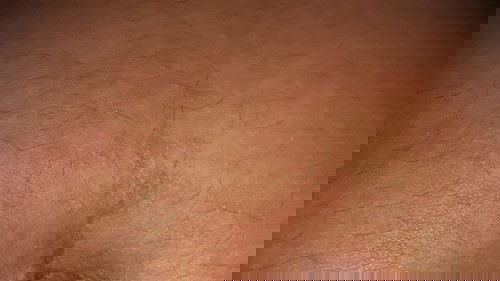 Kalo muncul bintik² merah² gatal di sekitar pusar itu normal gak Bun😔