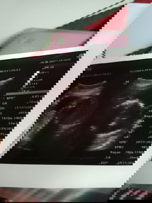 Hasil usg Minggu ke 26