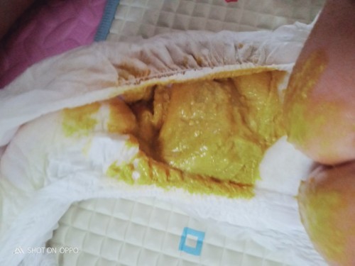 Hai ibu²..nk tnya normal ke najis baby sy cm ni..baby full fm susu Dupro..dia poo² xnangis pn..
