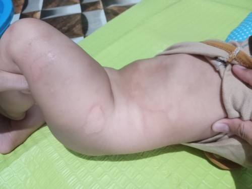 Iritasi kulit atau alergi ?