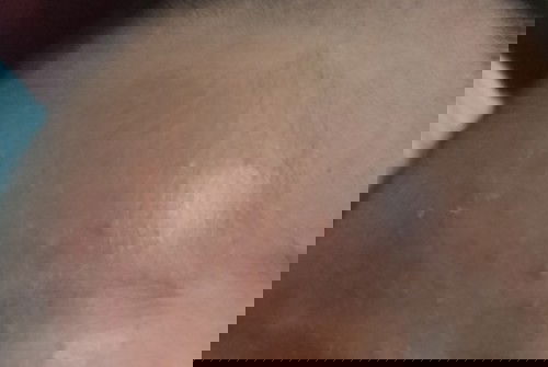 beruntusan wajah newborn