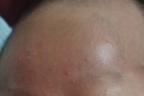 beruntusan wajah newborn