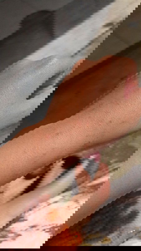 Dari hamil jalan 3minggu mulai gatel2😭