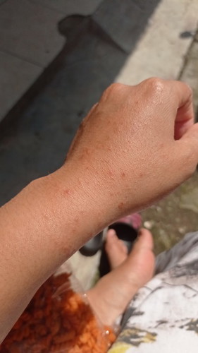 Dari hamil jalan 3minggu mulai gatel2😭