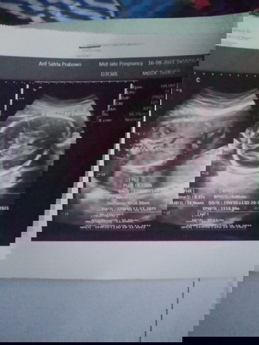 Hasil USG kata dokter nya air ketuban ya sedikit😑
Cara nambahin nya gimna?
Da yang tau
