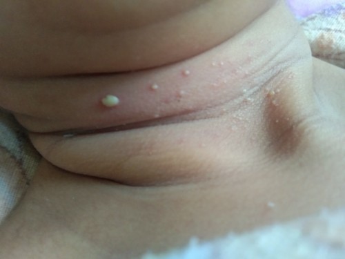 Ini koreng apa ya pada bayi 5 hari?