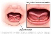 Any tips po para mapabilis ang pagsasalita ng anak ko? Tongue tie daw po sya..ehh medyo worried lng.