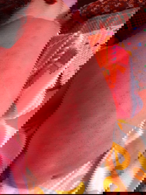 ลูกมีผื่นเเพ้ทำไงดีค่ะ