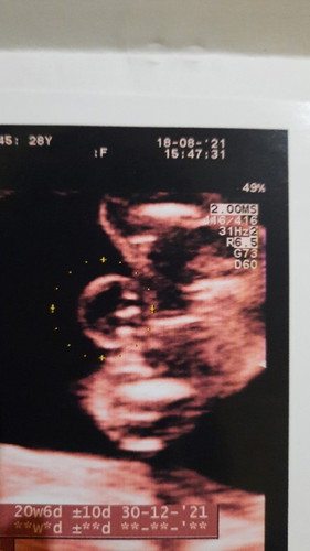 Apa penyebab posisi janin 5 bulan di bawah?