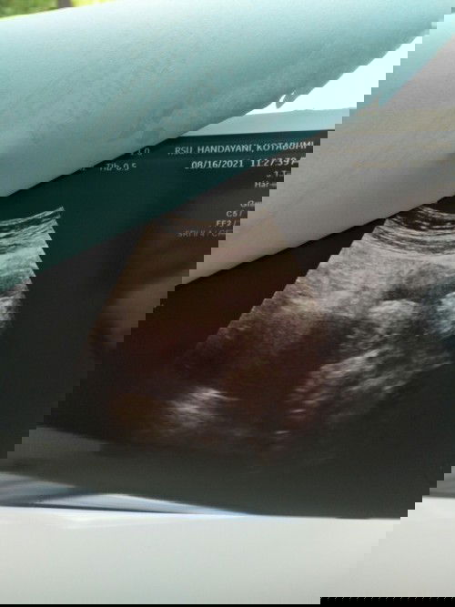 Penebalan dinding rahim usia 4week